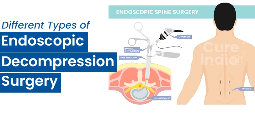 Different Types of Endoscopic Decompression Surgery in India
